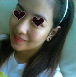 方下巴手术3个月后 美丽咯~~