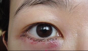 八一八我的切除眼袋全过程！~