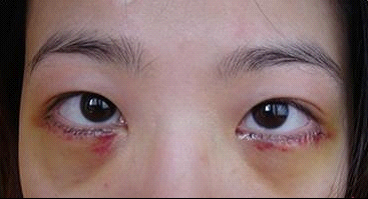 八一八我的切除眼袋全过程！~