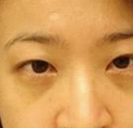 八一八我的切除眼袋全过程！~