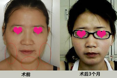 面部吸脂术前术后对比照