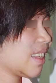 龅牙的悲催谁能懂？