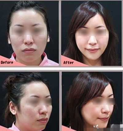 网友自述削骨经历 自此拥有精致小脸