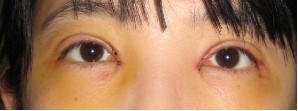我在上海做的双眼皮手术 给大家分享一下