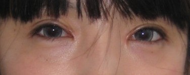 做完双眼皮加开眼角一个多月后眼角有点疤痕增生，不过幸好的是黄色已经消退