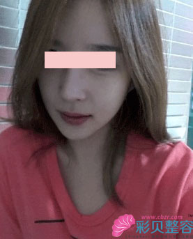 方下巴＋颧骨整形后我简直自信心爆棚啊