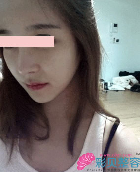 方下巴＋颧骨整形后我简直自信心爆棚啊