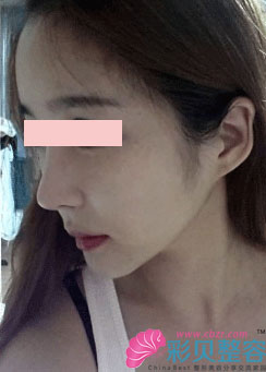 方下巴＋颧骨整形后我简直自信心爆棚啊