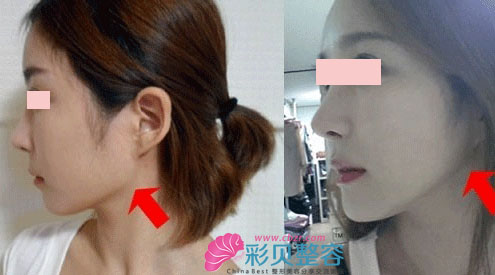 整形前后对比照，轮廓更流畅啦，变美后不想看太多整形前的照片，对比太明显~~