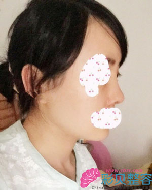 做的鼻梁，鼻头有缩一点，但是没有垫鼻尖，侧面看着挺美，很自然。七天拆线的时候，侧面能看到鼻小柱的切口，也不明显。这样感觉还不错的。