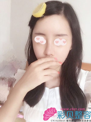 一个月的时候拍的照，鼻头还有点肿，眉心也是有点鼓。正面看是不是鼻尖短了一点呢？我很在意呀~~~