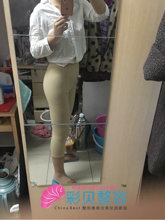 我越来越期待术后瘦身成功的样子了