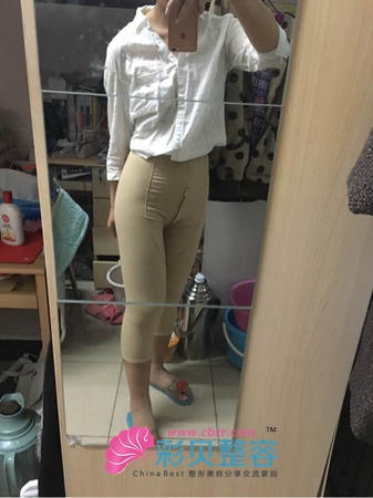 我的腿部吸脂日记