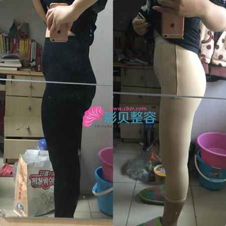 我的腿部吸脂日记