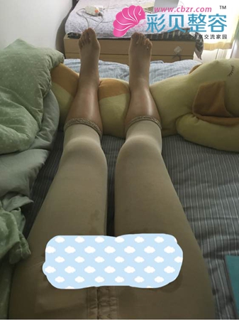 我的腿部吸脂日记