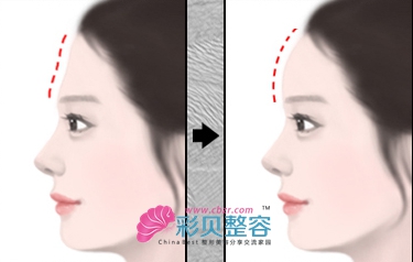 请听讲：丰额头术的两大绝招