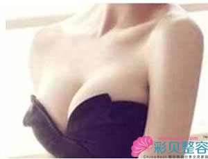 妙桃假体隆胸 “挺”的超自然