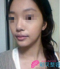 无下巴矫正后我变瓜子脸啦