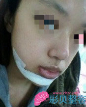 无下巴矫正后我变瓜子脸啦