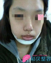 无下巴矫正后我变瓜子脸啦