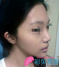 无下巴矫正后我变瓜子脸啦