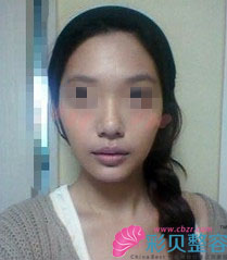 无下巴矫正后我变瓜子脸啦