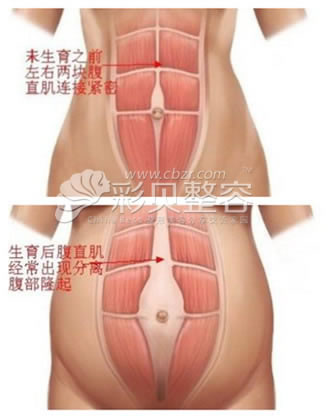 腹壁成形术原理示意图