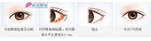 开外眼角手术示意图