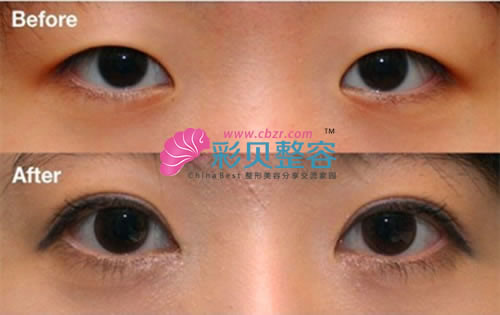 开内眼角手术案例对比图