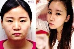 24岁女孩做全脸手术 只为变成“心形脸”