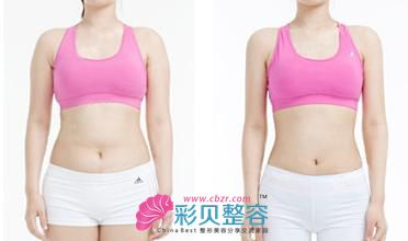吸脂前后对比