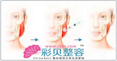 瘦脸针 真的不只是简单一针