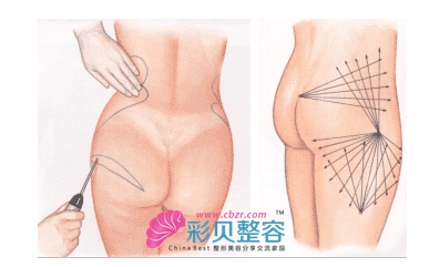 臀部吸脂