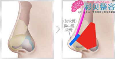 软骨延长鼻尖术