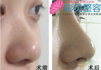 鼻尖延长前后对比