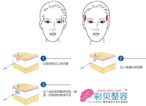 行之有效丰太阳穴的方法是哪种