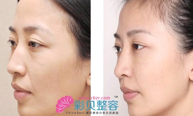 玻尿酸丰太阳穴效果图