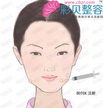 注射瘦脸针方法