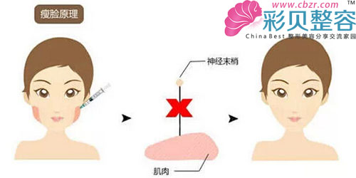 瘦脸针原理