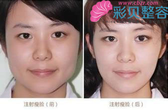 注射瘦脸针前后对比