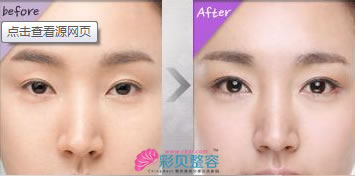 开外眼角手术案例对比图