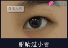 开眼角手术适用人群