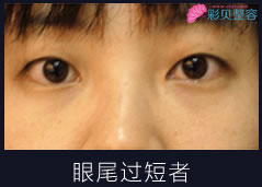 开眼角手术适用人群
