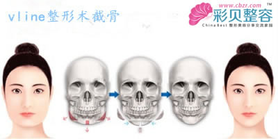 vline手术原理