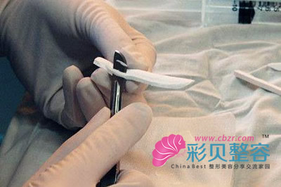 医生雕刻膨体材料