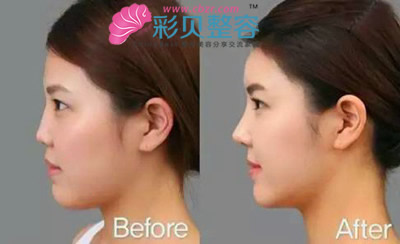 用膨体材料隆鼻易感染 你是在逗我吗