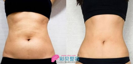 腰腹吸脂前后对比图