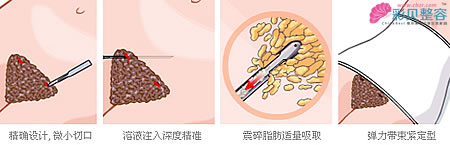 腰腹吸脂减肥手术过程