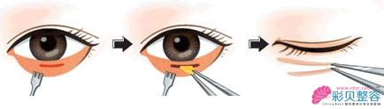 内切去眼袋手术过程图