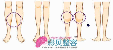 瘦腿针瘦小腿示意图